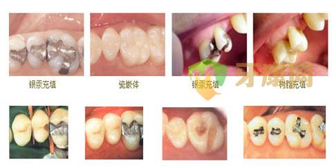 儿童龋齿检查