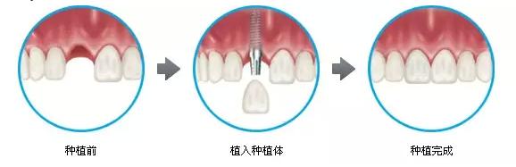 牙齿种植有什么危害？