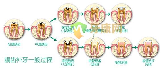 怎么检查是否蛀牙