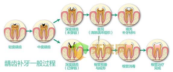 儿童补牙要杀神经吗