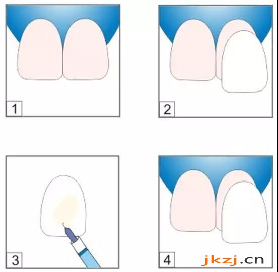 牙齿贴片操作方式