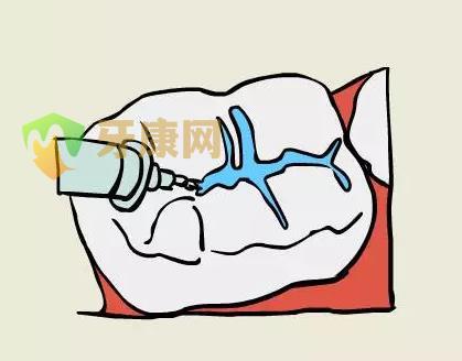 窝沟封闭要做几个