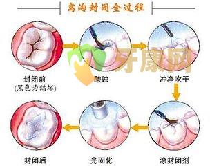 做窝沟封闭疼吗