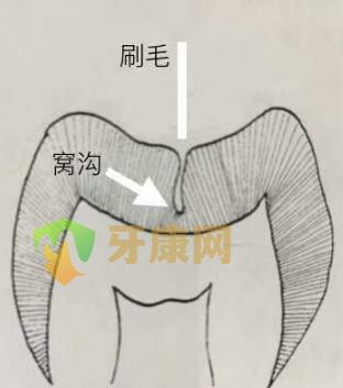 窝沟封闭几岁做比较好