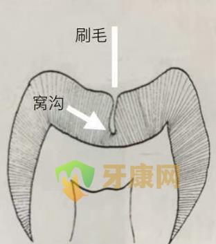 窝沟封闭