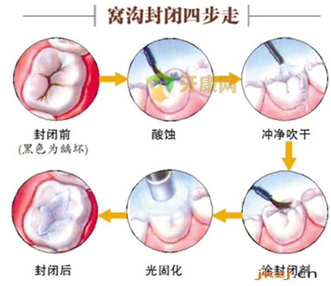 牙齿窝沟封闭多久做