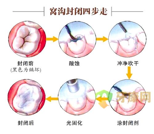 窝沟封闭的年龄