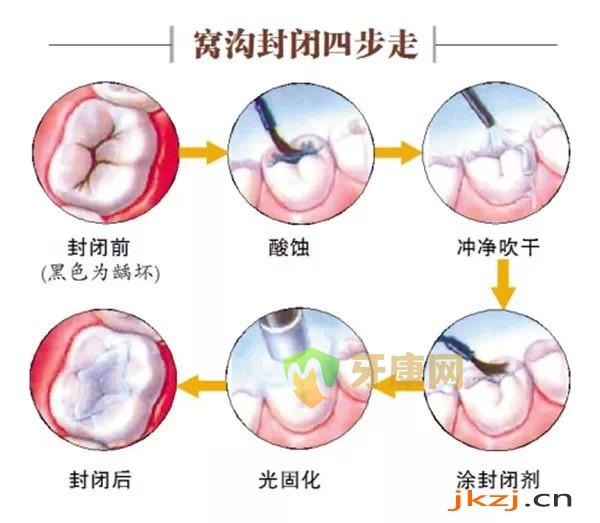 儿童窝沟封闭的价格