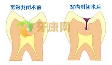 做窝沟封闭价格