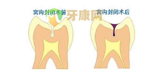 什么是窝沟封闭