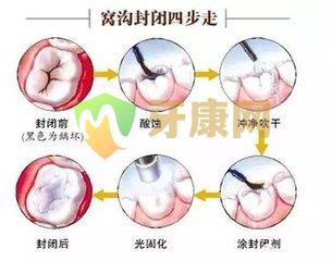 窝沟封闭几岁做好