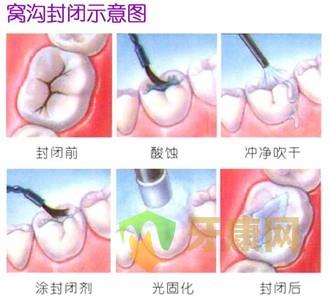 儿童蛀牙后做窝沟封闭有用吗