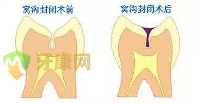 孩子做窝沟封闭的价格如何