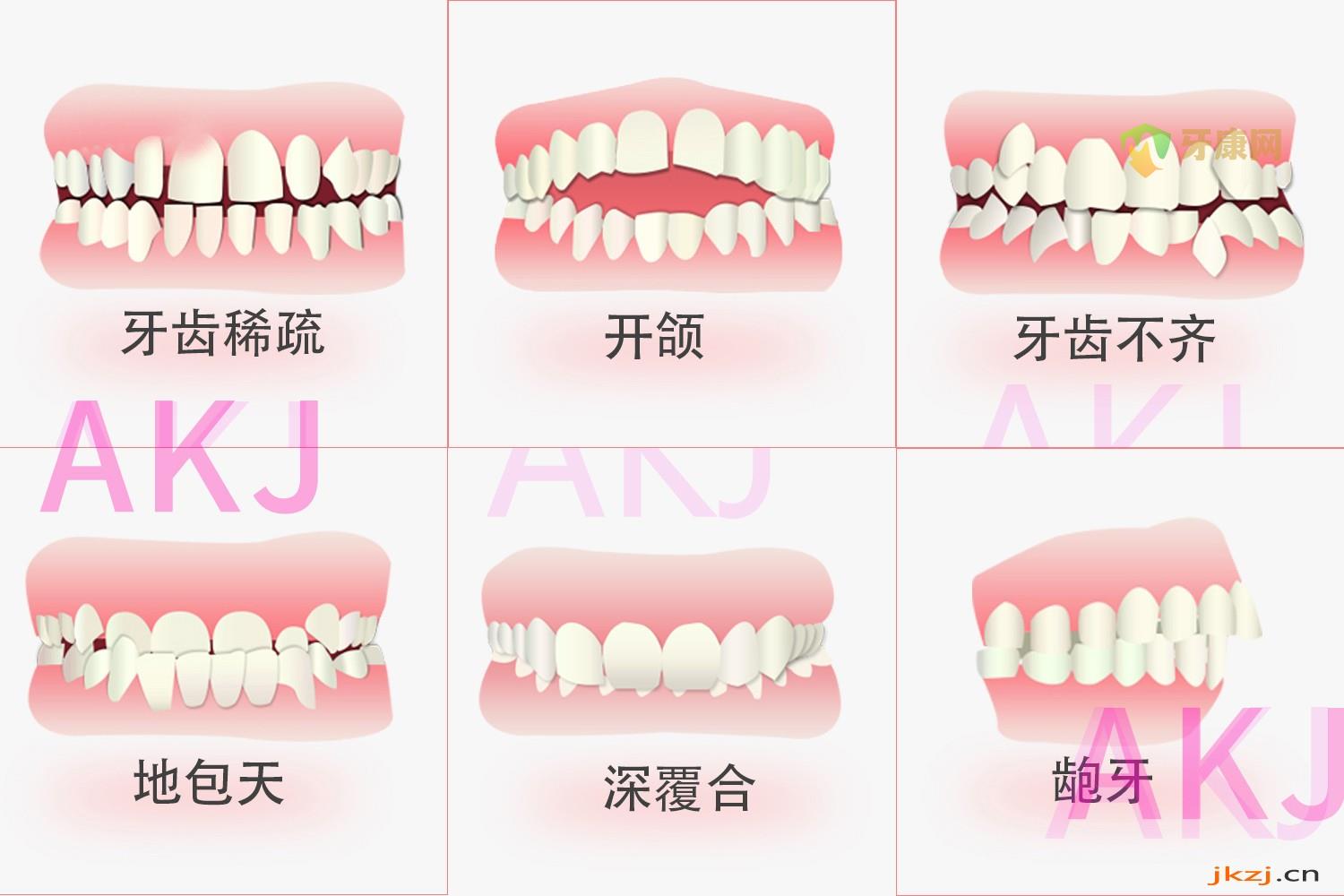 牙齿咬合关系示意图片