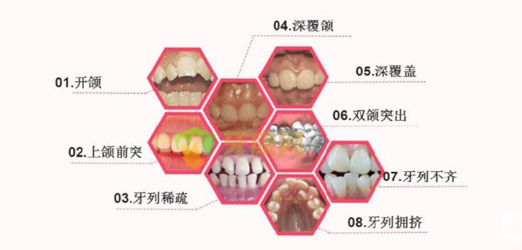 常见的咬合不齐