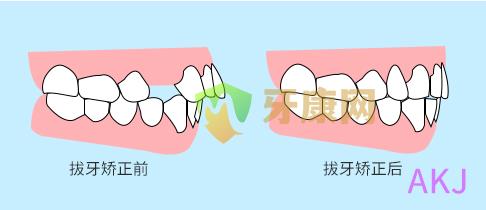 矫正